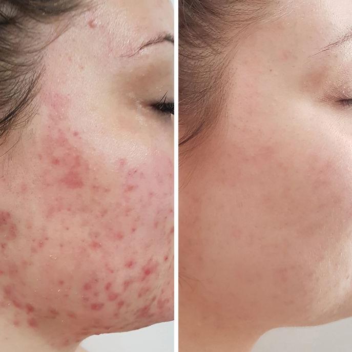 Acne & Open Pores collection
