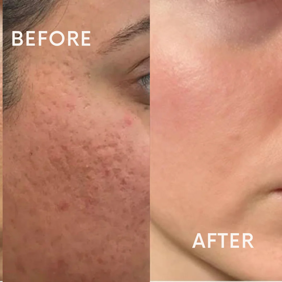 Open Pores & Dull Face Treatment Combo Kit | All Skin Types thumbnail 2