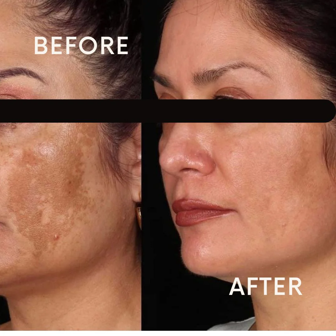 Pigmentation & Dark Spots collection
