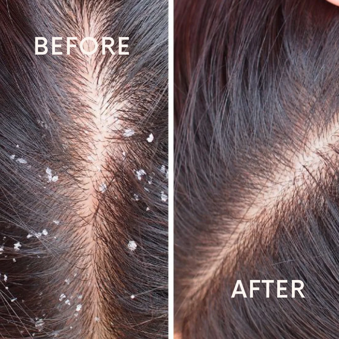 Coconut and Ashwagandha Anti-Dandruff Shampoo | All Scalp & Hair Types thumbnail 3
