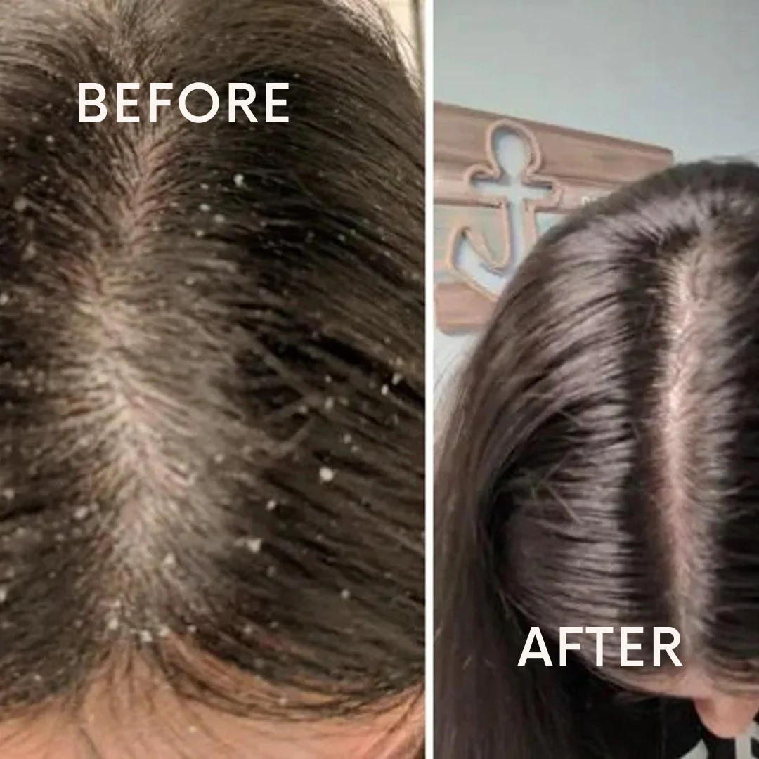Coconut and Ashwagandha Anti-Dandruff Shampoo | All Scalp & Hair Types thumbnail 2